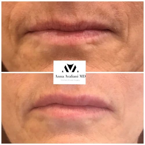 Lip Augmentation before and after, result 65