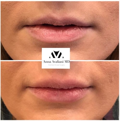 Lip Augmentation before and after, result 45