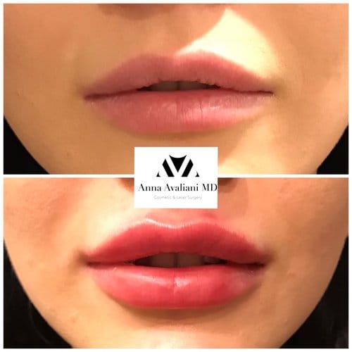 Lip Augmentation before and after, result 66