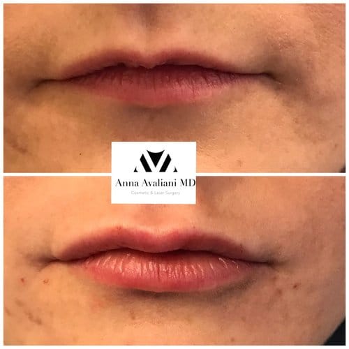 Lip Augmentation before and after, result 67