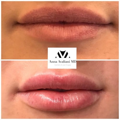 Lip Augmentation before and after, result 68