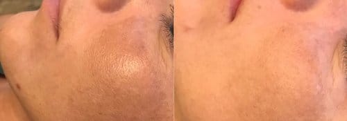PicoSure / Laser Skin Rejuvenation before and after, result 32