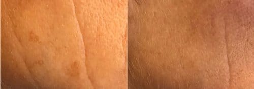 PicoSure / Laser Skin Rejuvenation before and after, result 41