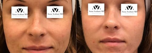 PicoSure / Laser Skin Rejuvenation before and after, result 42