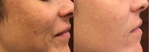 PicoSure / Laser Skin Rejuvenation before and after, result 43