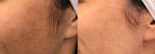 PicoSure / Laser Skin Rejuvenation before and after, result 44