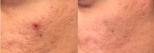 PicoSure / Laser Skin Rejuvenation before and after, result 45