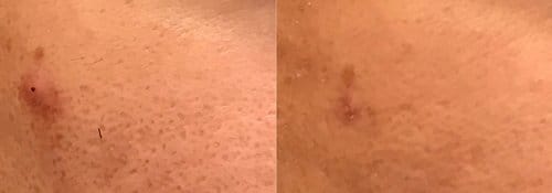 PicoSure / Laser Skin Rejuvenation before and after, result 46
