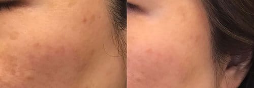 PicoSure / Laser Skin Rejuvenation before and after, result 47