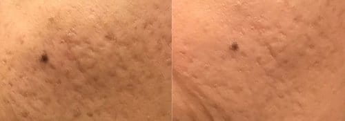 PicoSure / Laser Skin Rejuvenation before and after, result 48
