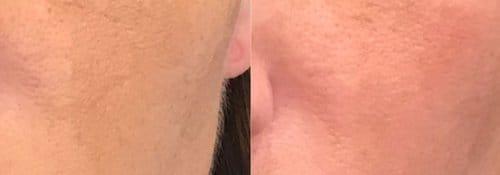 PicoSure / Laser Skin Rejuvenation before and after, result 33