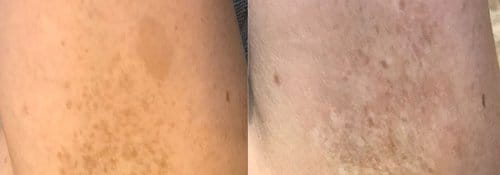 PicoSure / Laser Skin Rejuvenation before and after, result 34