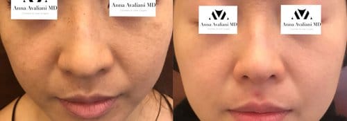 PicoSure / Laser Skin Rejuvenation before and after, result 35