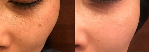 PicoSure / Laser Skin Rejuvenation before and after, result 36