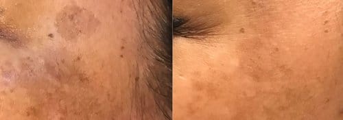 PicoSure / Laser Skin Rejuvenation before and after, result 37