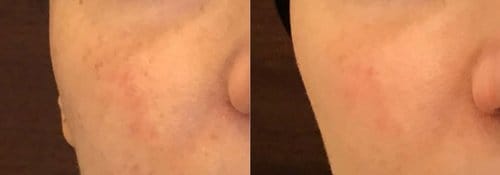 PicoSure / Laser Skin Rejuvenation before and after, result 38