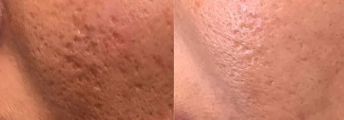 PicoSure / Laser Skin Rejuvenation before and after, result 39