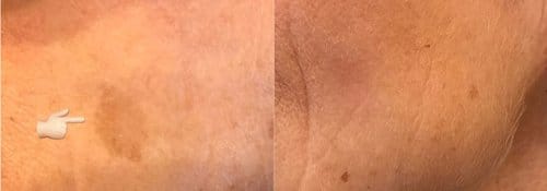 PicoSure / Laser Skin Rejuvenation before and after, result 40