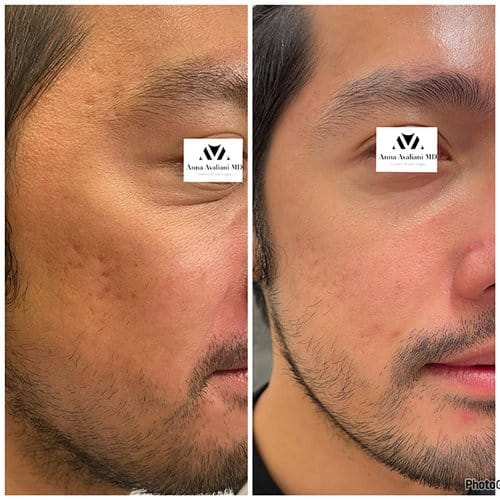 Microneedling before and after, result 1
