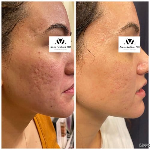 Microneedling before and after, result 2