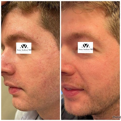 Microneedling before and after, result 3