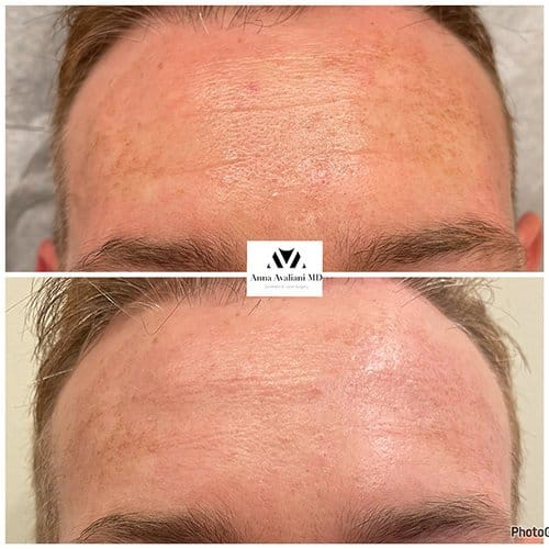 Microneedling before and after, result 4