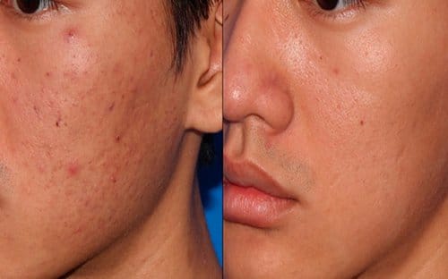Microneedling before and after, result 5