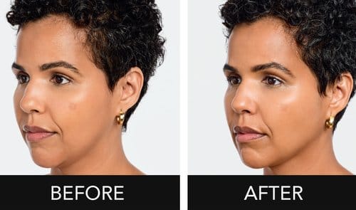 Radiesse before and after, result 3