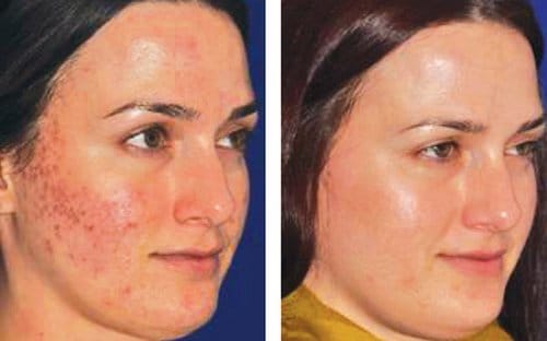Microneedling before and after, result 7