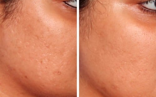 Microneedling before and after, result 6