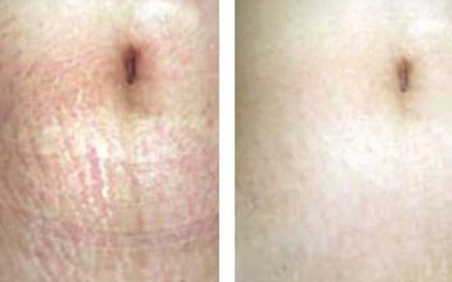 Microneedling before and after, result 8