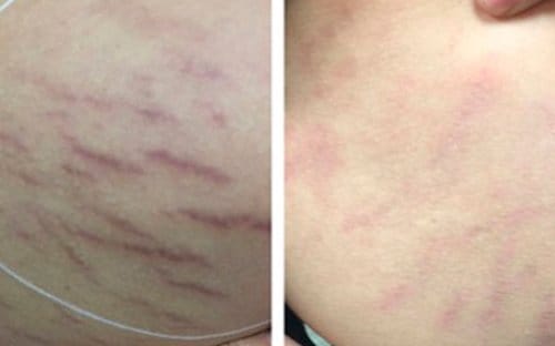 Microneedling before and after, result 9
