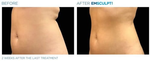Emsculpt NEO before and after, result 7