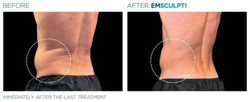 Emsculpt NEO before and after, result 10