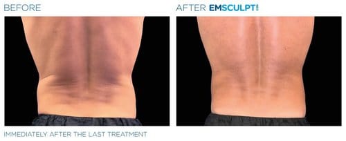 Emsculpt NEO before and after, result 8