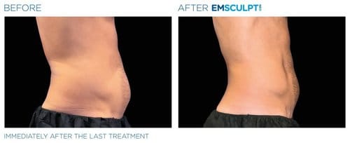 Emsculpt NEO before and after, result 9