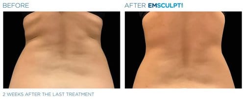 Emsculpt NEO before and after, result 6