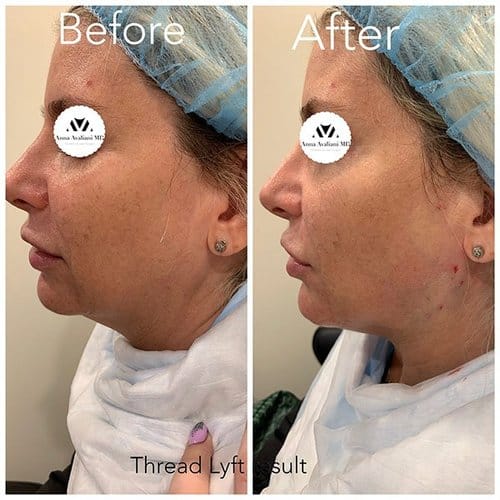 Face Threads before and after