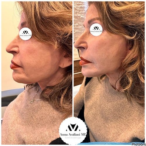 Face Threads before and after