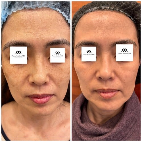 PicoSure / Laser Skin Rejuvenation before and after, result 7