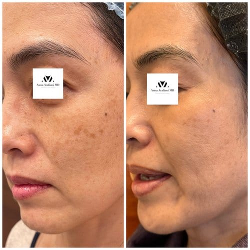 PicoSure / Laser Skin Rejuvenation before and after, result 6