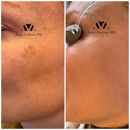 PicoSure / Laser Skin Rejuvenation before and after, result 5