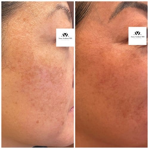 PicoSure / Laser Skin Rejuvenation before and after, result 4