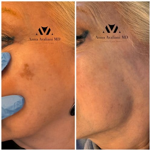 PicoSure / Laser Skin Rejuvenation before and after, result 3