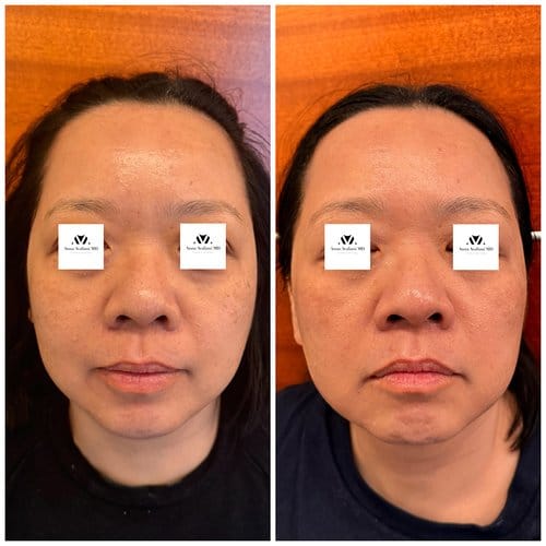 PicoSure / Laser Skin Rejuvenation before and after, result 2