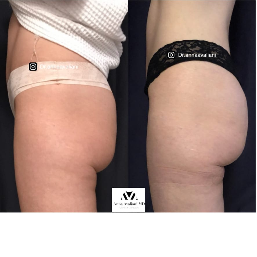 Radiesse butt side view before and after, Dr. Avaliani NYC