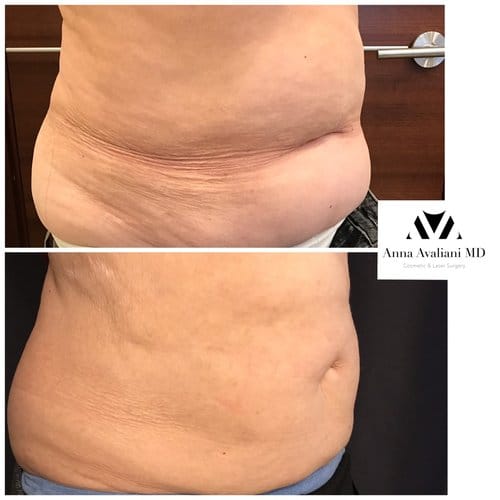 SculpSure before and after