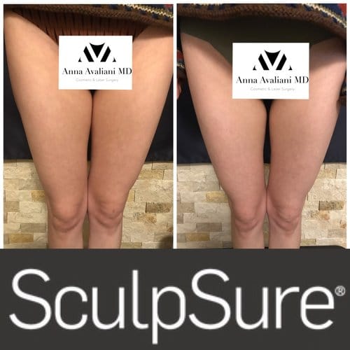 SculpSure before and after, result 10
