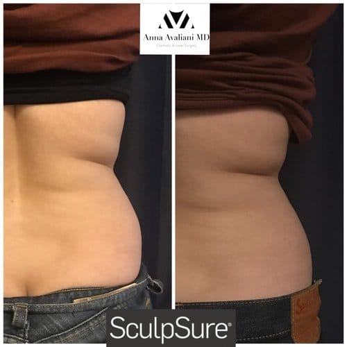 SculpSure before and after, result 11