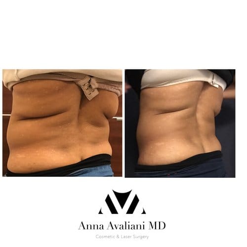SculpSure before and after, result 12